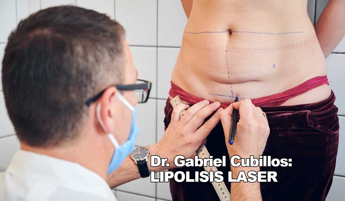 Dr. Gabriel Cubillos: Lipolisis láser, cuánto tiempo se ven resultados